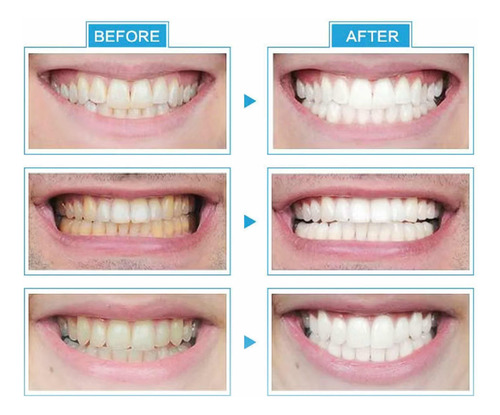 Instrumento De Blanqueamiento De Dientes