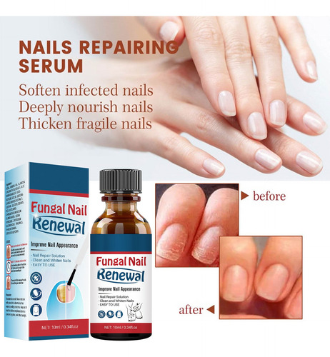 Set Reparador De Uñas Extra Fuerte K Nail Toenail Fingernail