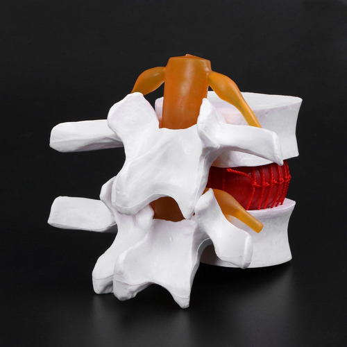New Style Modelo De Hernia Discal Lumbar Anatómica Humana