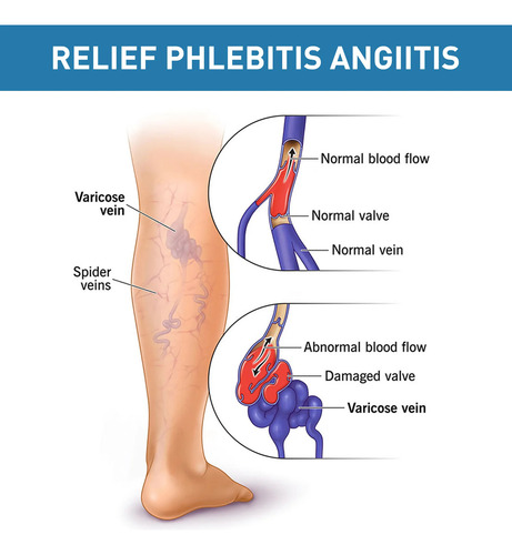 Crema Para Aliviar La Vasculitis, Flebitis, Lombriz, Patas D