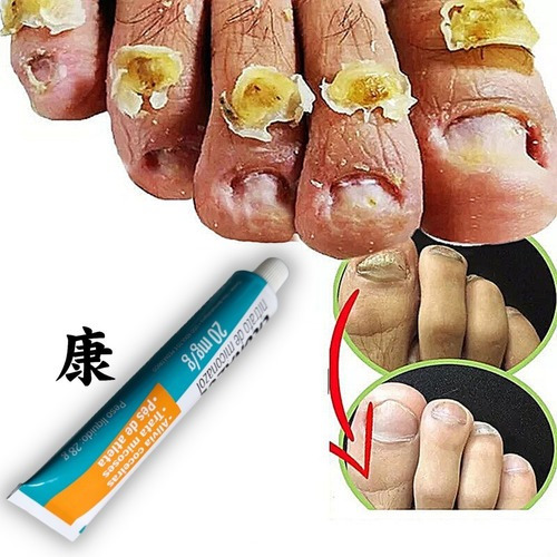 Pomada Pra Fungos Nos Pés Odor Micose Chulé Micoses De Unha