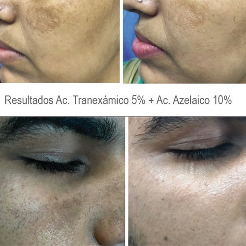 Imagen 7 de 7 de Kit Booster Azelaico 10% + Tranexámico 5% Melasma Manchas Tipo De Piel Piel Pigmentada