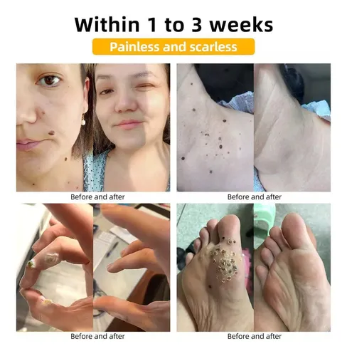 5×crema Para Eliminar Etiquetas Veneno Abeja