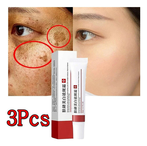 Crema Blanqueadora Para Pecas Eliminar El Melasma Acné Spot