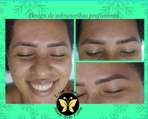 Imagem 1 de 5 de Tratamento De Estrias, Micropimentação, Epilação, Limpeza Fa