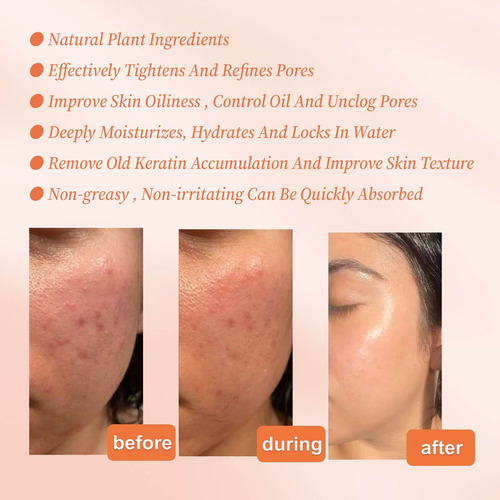Sérum Facial Para Cuidados Com A Pele Pore Para Reduzir Os P
