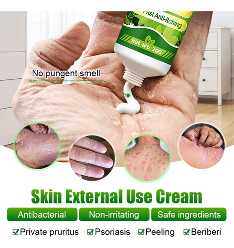 Crema Para La Psoriasis Y El Eczema, Crema Anti Picazón A