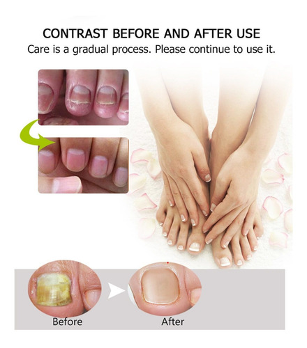 Gel Reparador De Uñas Efero, 2 Unidades, Tratamiento De Uñas