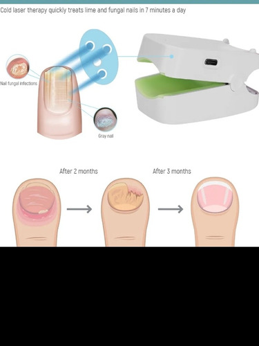 Láser Eliminación Para Hongos Uñas (onicomicosis)