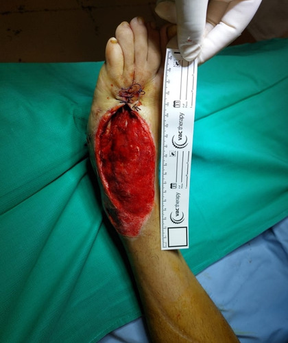 Imagen 4 de 5 de Vac Alquiler Heridas Terapia Pie Diabetico