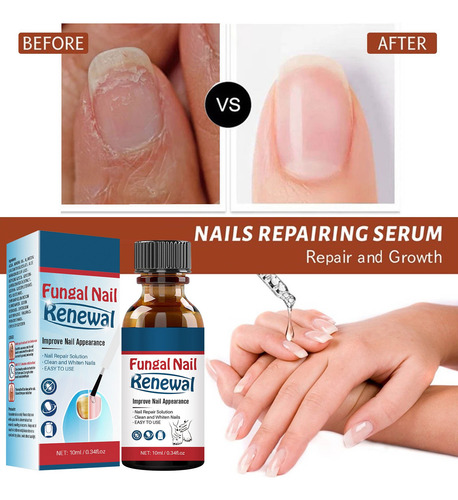 Set Reparador De Uñas Extra Fuerte K Nail Toenail Fingernail