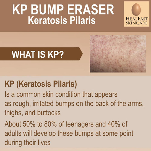 Crema De Borrador De La Protuberancia De Kp Kp Para La Piel