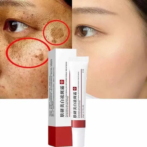 Creme Facial Clareador Melasma Acne Sardas Manchas Escuras Moment...