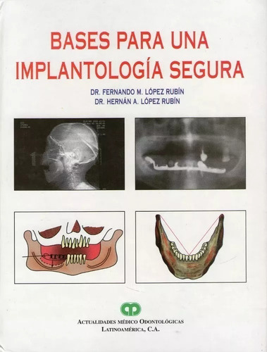 Bases Para Una Implantología Segura