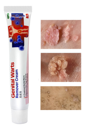 Creme Tira Verruga Hpv Coceiras Manchas Fungos Neutra