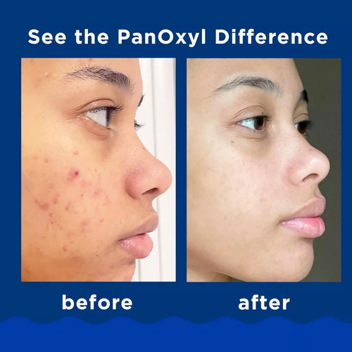 X Jabón Espumoso Para El Acné Panoxyl, Peróxido De