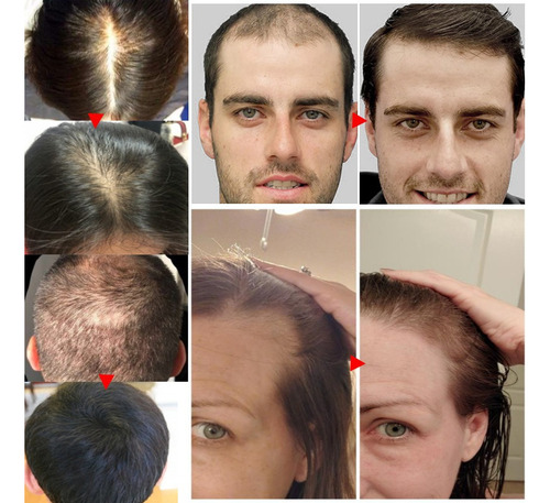 Produto Para O Cabelo Crescer Muito Rápido, Nutrindo, Evitan