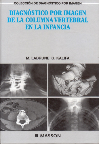 Diagnóstico Por Imagen De La Columna Vertebral En Infancia