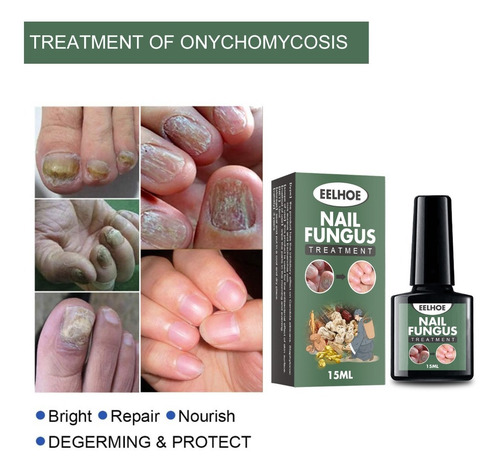 Alivia Uñas Enterradas Elimina Onicomicosis Nail Fungus