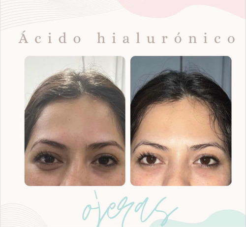 Aplicación De Botox (toxina Botulínica)