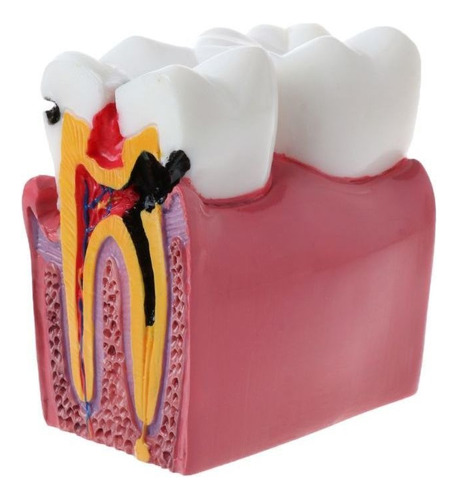 Modelo De Dientes De Anatomía De Comparación De Caries Denta