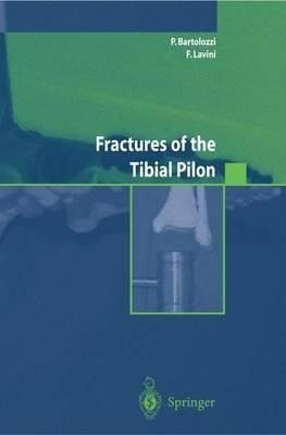 Fractures Of The Tibial Pilon - Pietro Bartolozzi (paperb...