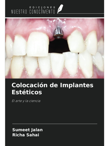 Libro: Colocación De Implantes Estéticos: El Arte Y La Cienc