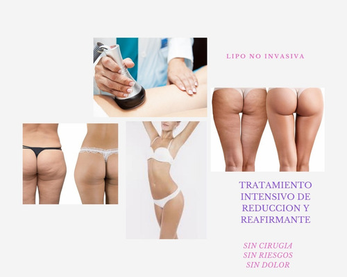 Imagen 3 de 6 de Ultracavitacion + Vacuum/radio +reductor Lipo S/cirugía 6+2