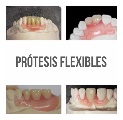 Imagen 4 de 5 de Prótesis Dental, Prótesis Fija
