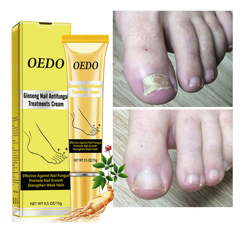 Crema Para Hongos Oedo-nail, Cuidado De Los Pies, Antifúngic