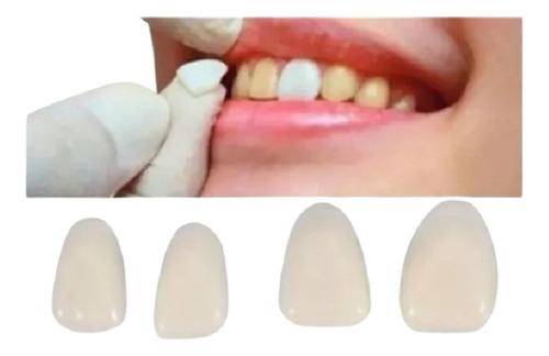 14 Facetas Resina + Massa Fixadora.  Dentes Postiços.