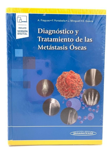 Diagnóstico Y Tratamiento De Las Metástasis Óseas Fraguas