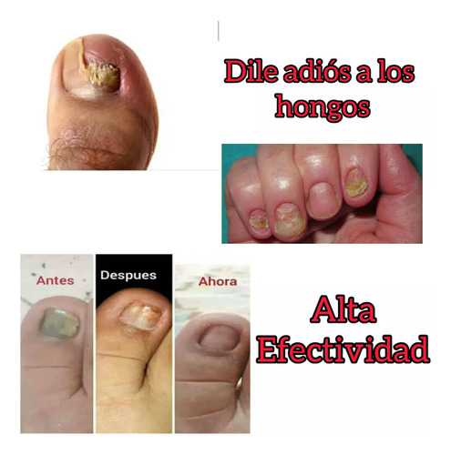 Formula Mejorada Suero Elimina Hongos En Uñas De Pie Y Mano