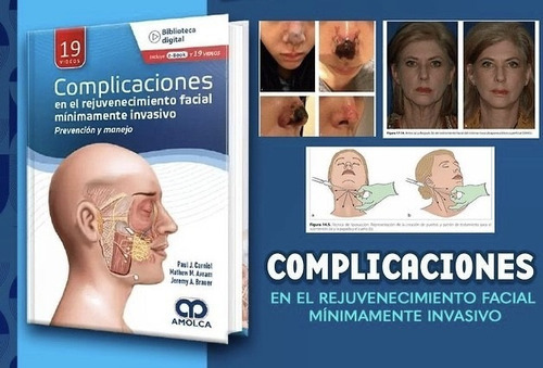 Complicaciones En El Rejuvenecimiento Facial Minimament,jk