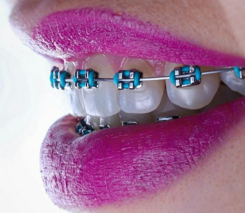 Ortodoncia Con Brackets Zafiro