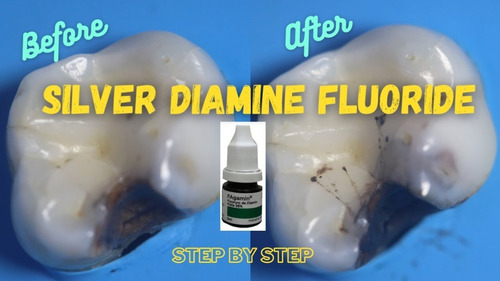 Imagen 7 de 7 de Fagamín Fluoruro Diamino Plata Dental 5ml Santiago