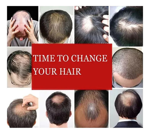 2025 Kit 2 Prótesis Capilares Naturales Orgánicas For Hombre