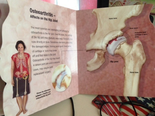 Libro Understanding Arthritis Con Imágenes En 3d