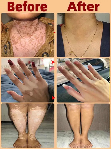 Crema Tratamiento Profesional Para Eliminar El Vitiligo Original