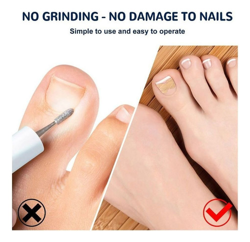 Parches Correctores De Uñas Encarnadas Para Corrección De Uñ
