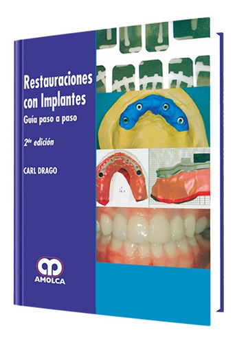 Restauraciones Con Implantes. Guía Paso A Paso. 2ª Edición.