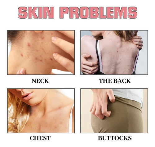 Jabón De Baño Exfoliante Para Eliminar El Acné Las Manchas O