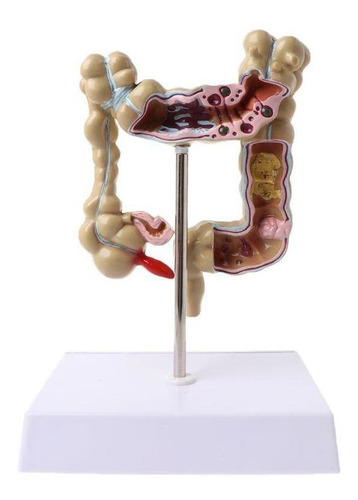 Modelo De Intestino Grueso Con Lesión De Colon Humano