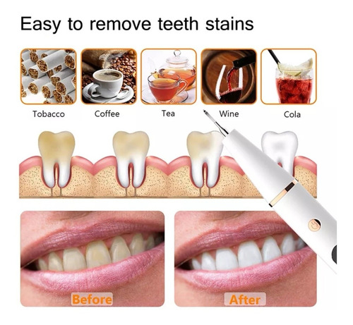 Kits Blanqueamiento Dental Sonic Clean - Raspador Eléctrico