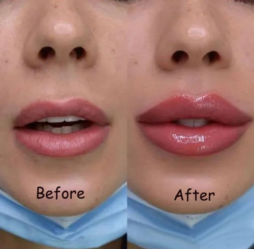 Lip Plump Volume Imediato Nos Lábios Com Acid Hialuronic