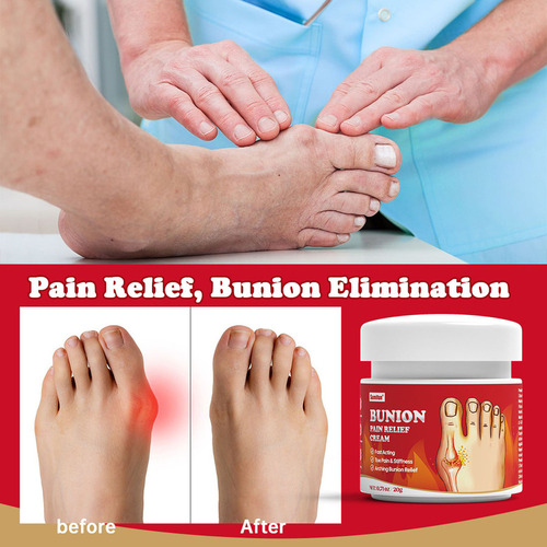 Ungüento Para El Dolor De Juanetes, Pomada Para El Reumatism