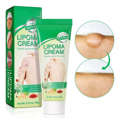 Pomada Cremosa Eliminadora De Lipomas Para Tratamento