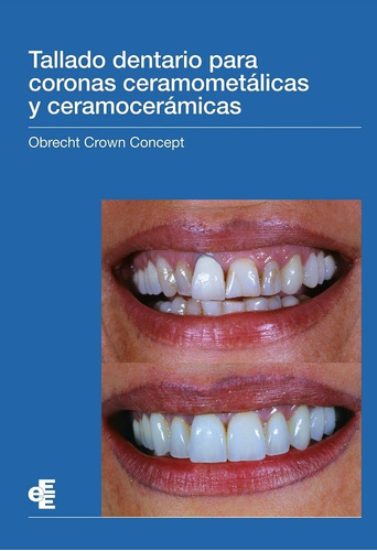 Tallado Dentario Para Coronas Ceramometálicas Y Ceramocer...