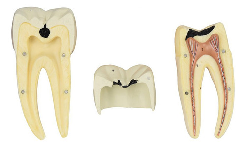 Molar Inferior Com Raiz Dupla Cárie, Em 3 Partes Ampliado 8x