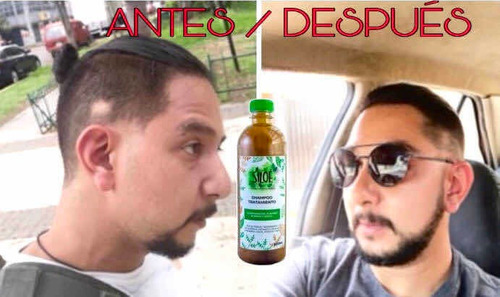 Adiós Calvicie, Alopecia, Psoriasis Pack 5 Shampoo Siloe